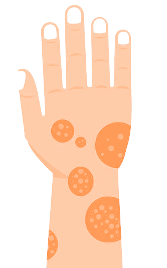 علاج الصدفية